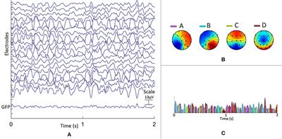 Normal Aging: Alterations in Scalp EEG Using Broadband and Band-Resolved Topographic Maps